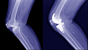 Osteoarthritis